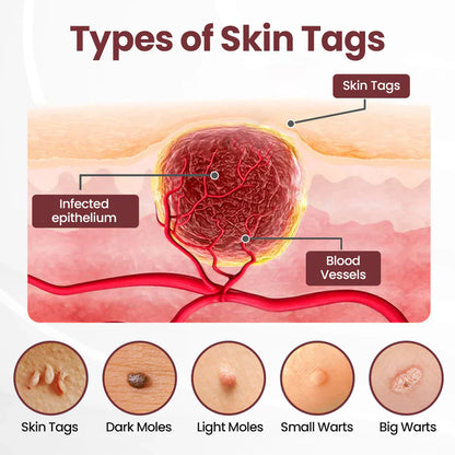 💗✅AU Owned and Operated：Pheromex®Dual-Action Plant Wart Removal Cream（👨‍⚕️Skin Tags,Acne,Hyperpigmentation,Eczema,Psoriasis,Rosacea,Warts)