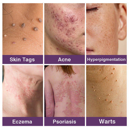 AU Owned and Operated：Pheromex®Dual-Action Plant Wart Removal Cream