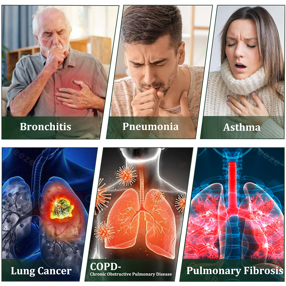 💖💖🇦🇺 Official Store:CareBreeze® 6-in-1 Herbal BeePropolis Lung Cleanse Spray🐝（👨‍⚕️Directly acts on COPD, asthma, chronic bronchitis (CB), respiratory infections, lung cancer, sinusitis, and other conditions）